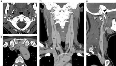 Life changing response to successive surgical interventions on cranial venous outflow: A case report on chronic fatigue syndrome